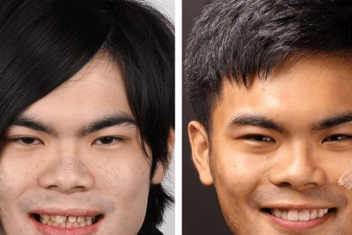 一口爛牙不敢笑!!搖滾樂手透過陶瓷貼片恢復自信的心得分享