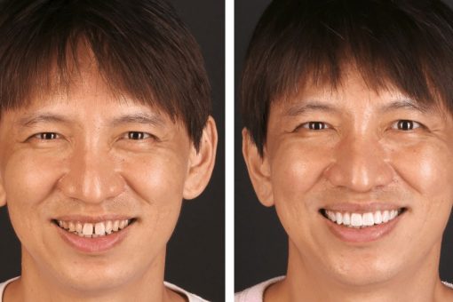 男生門牙縫推薦陶瓷貼片，不用戴矯正牙套