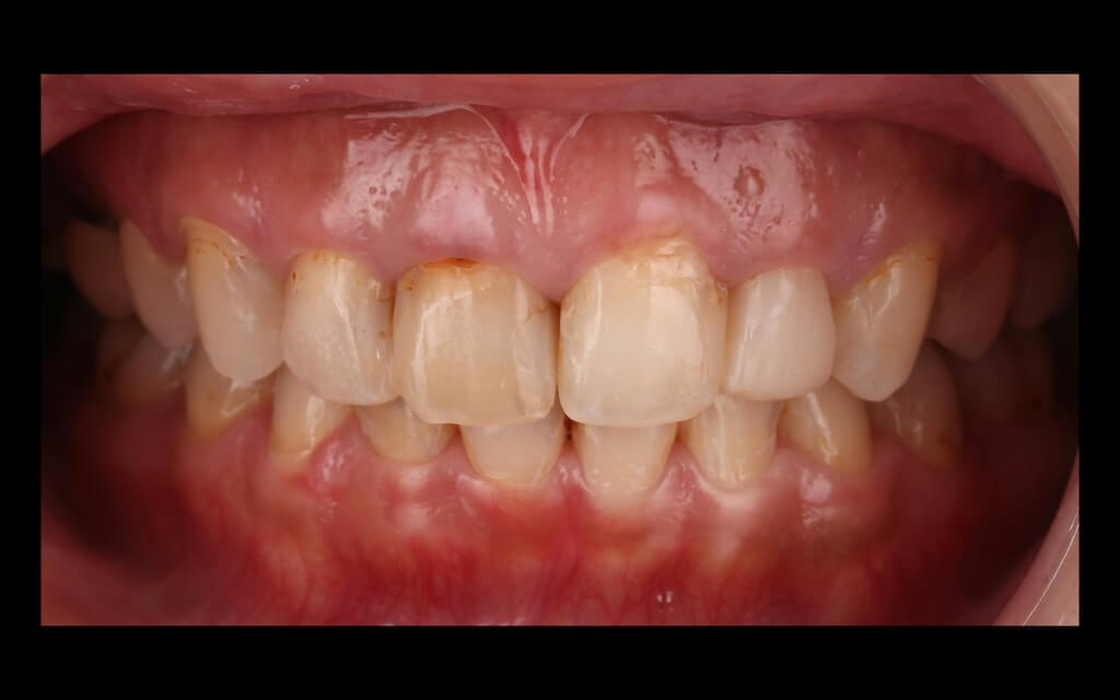 陶瓷貼片心得-牙齒黃術前照-台中瓷牙貼片推薦-牙齒美白-朗日牙醫-劉得廷醫師