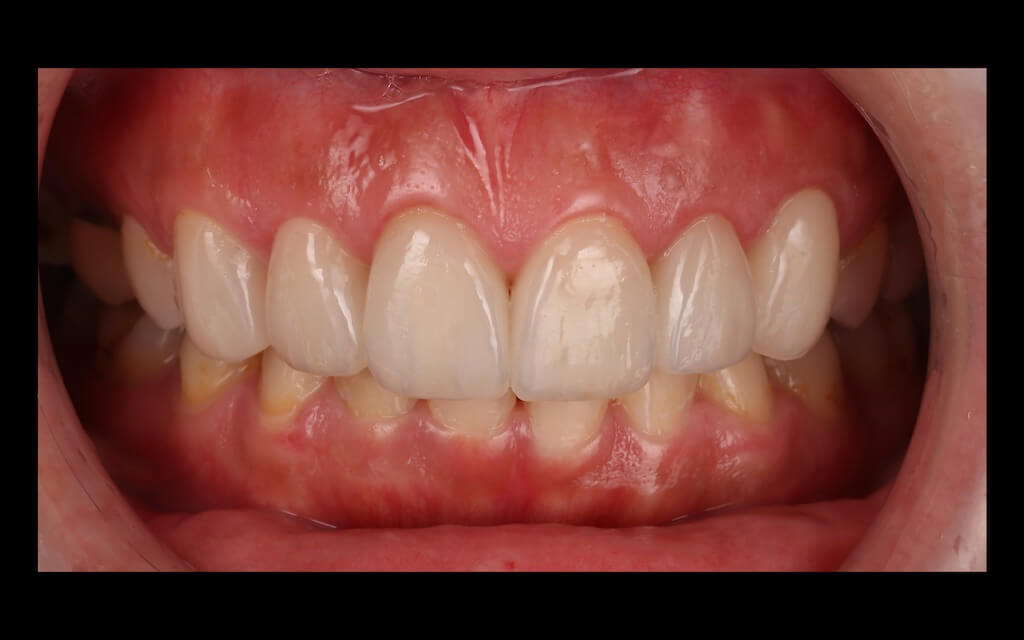 陶瓷貼片心得-牙齒黃術後照-台中瓷牙貼片推薦-牙齒美白-朗日牙醫-劉得廷醫師