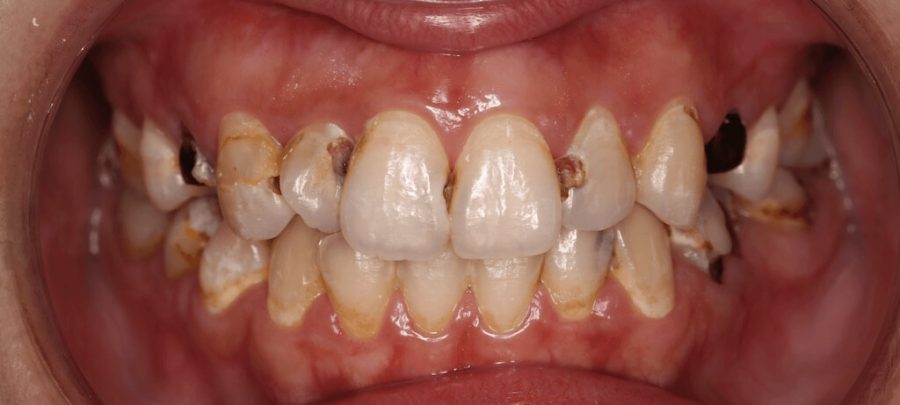 門牙蛀牙-牙齒黃-陶瓷貼片前-台中-劉得廷醫師