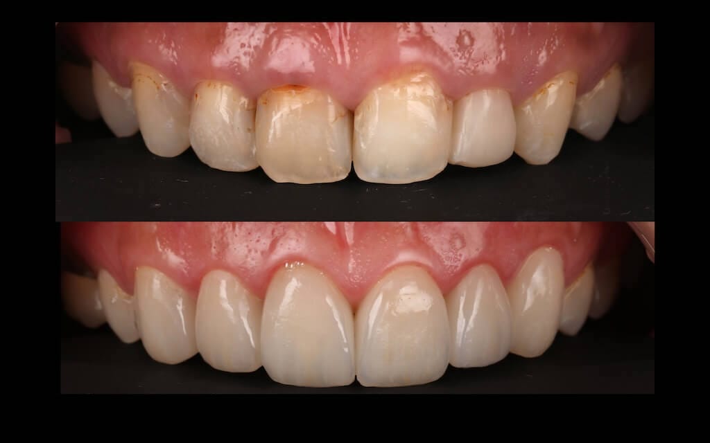 陶瓷貼片心得-牙齒黃-牙齒美白前後對比照-台中瓷牙貼片推薦-朗日牙醫-劉得廷醫師
