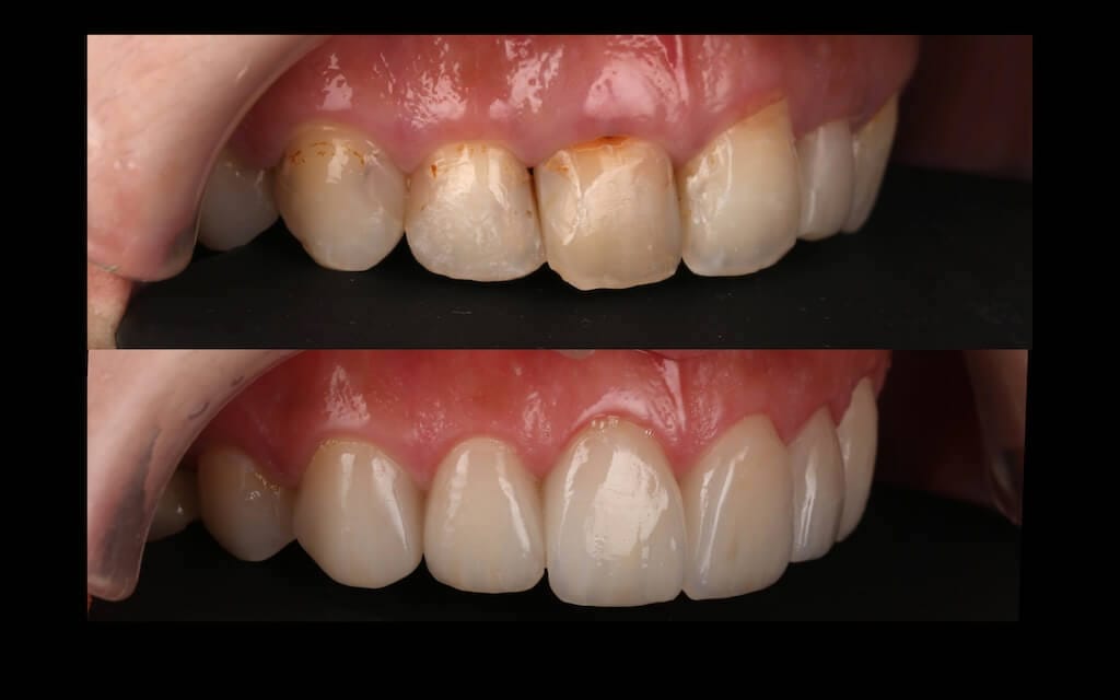 陶瓷貼片心得-牙齒黃-牙齒美白前後對比照側面-台中瓷牙貼片推薦-朗日牙醫-劉得廷醫師