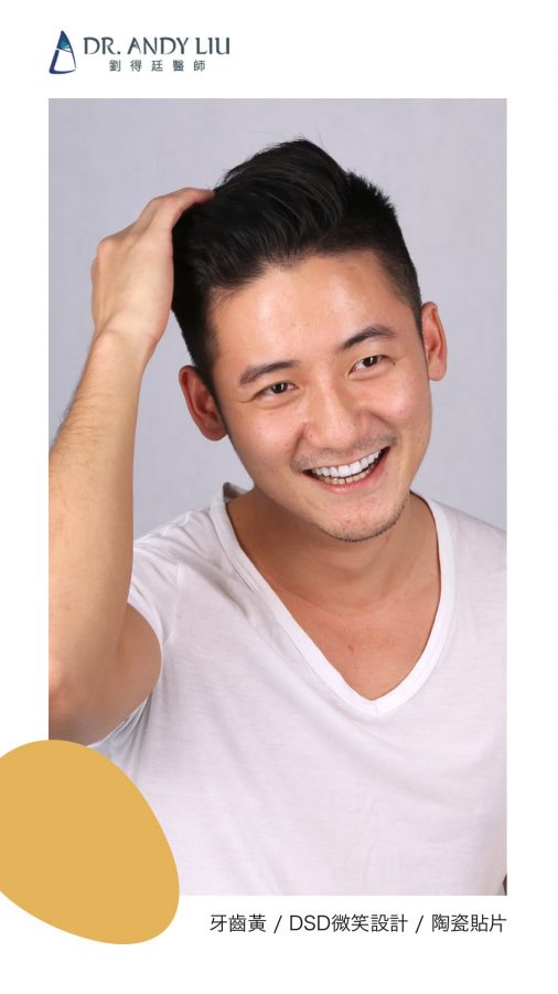 DSD微笑設計讓機師秒變型男!!牙齒黃與門牙缺角,瓷牙貼片一日美齒