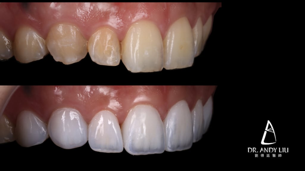 牙齒黃缺角用DSD數位微笑設計與陶瓷貼片-上排牙齒右側面