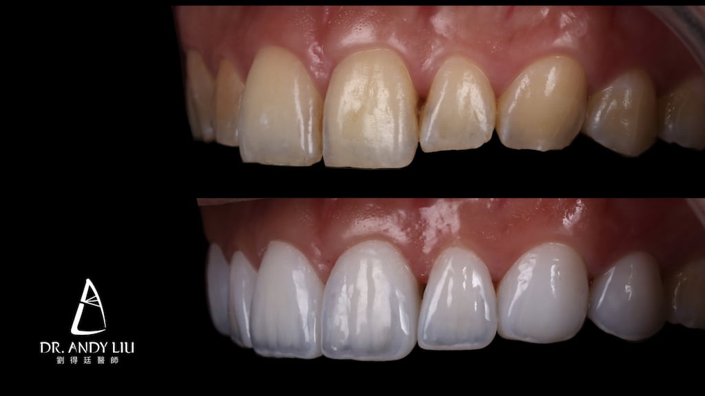 牙齒黃缺角用DSD數位微笑設計與陶瓷貼片-上排牙齒左側面