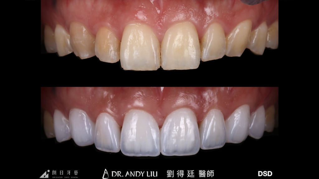 牙齒黃缺角用DSD數位微笑設計與陶瓷貼片-上排牙齒正面比較
