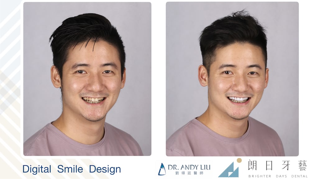 牙齒黃缺角用DSD數位微笑設計與陶瓷貼片-微右側笑容比較圖