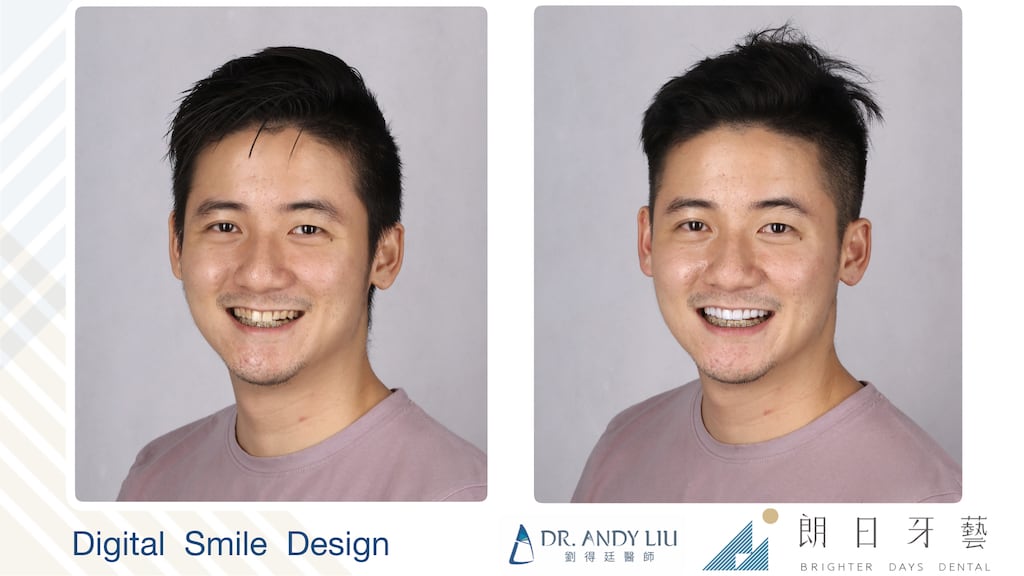 牙齒黃缺角用DSD數位微笑設計與陶瓷貼片-微左側笑容比較圖