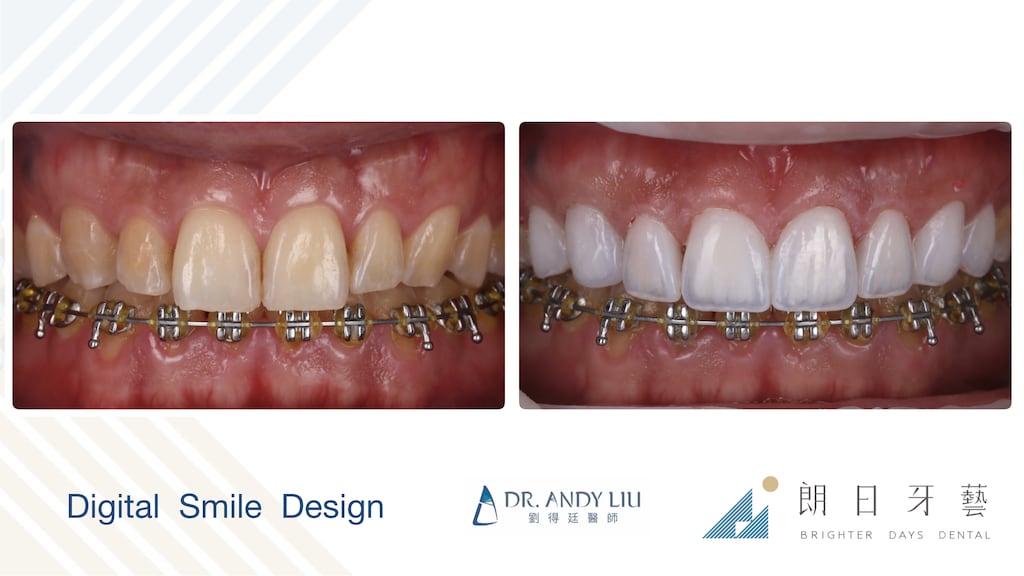 牙齒黃缺角用DSD數位微笑設計與陶瓷貼片-牙齒正面前後比較