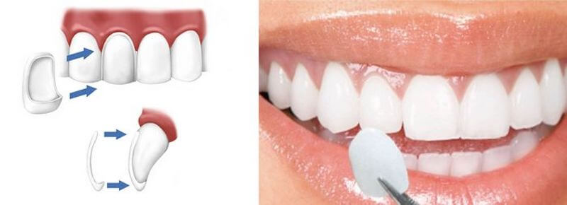 瓷牙貼片-陶瓷貼片-改善牙齒外觀與顏色