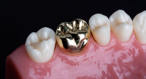 抽神經-根管治療-牙齒變黑-牙齒美白-傳統全金屬牙冠-台中-劉得廷醫師