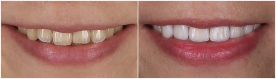 比牙齒矯正更快更美的瓷牙貼片牙齒整型心得推薦-術前術後微笑曲線比較