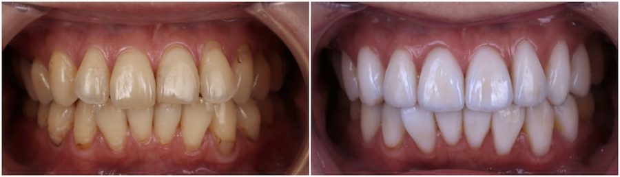 比牙齒矯正更快更美的瓷牙貼片牙齒整型心得推薦-術前術後牙齒比較