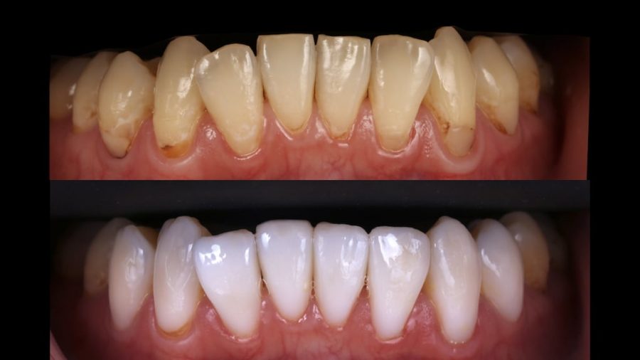 牙齒黃齒列不正免矯正-林小姐陶瓷貼片加DSD數位微笑修復推薦心得-術前術後下排牙齒正面比較
