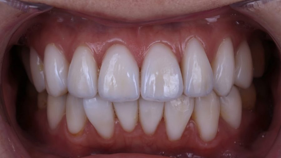 牙齒黃齒列不正免矯正-林小姐陶瓷貼片加DSD數位微笑修復推薦心得-術後門牙對稱且齒色自然