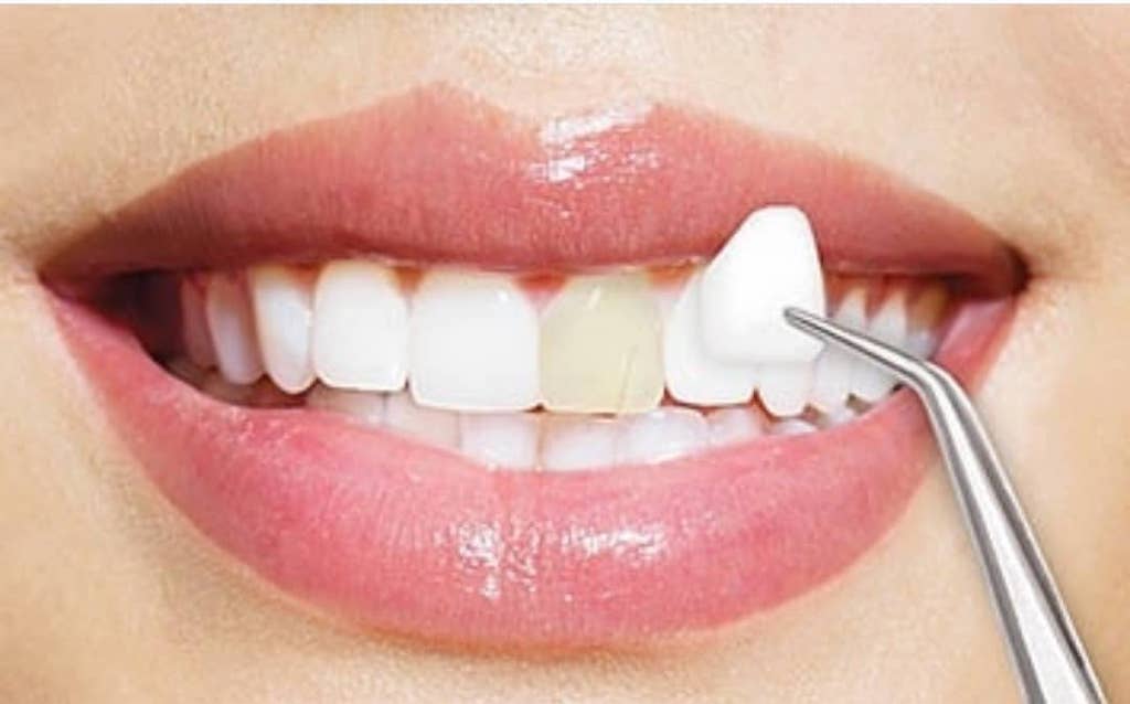 瓷牙貼片-牙齒美白-牙齒整型-瓷牙貼片壽命