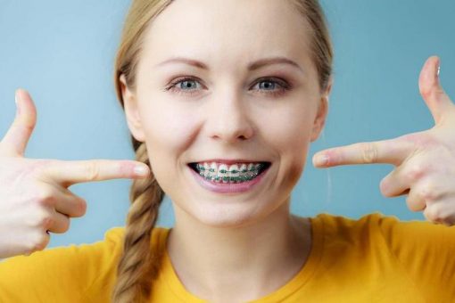 齒列不正傳統療程多用牙套-矯正器修正牙齒錯位-範例圖