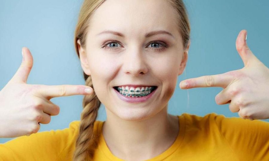 齒列不正傳統療程多用牙套-矯正器修正牙齒錯位-範例圖