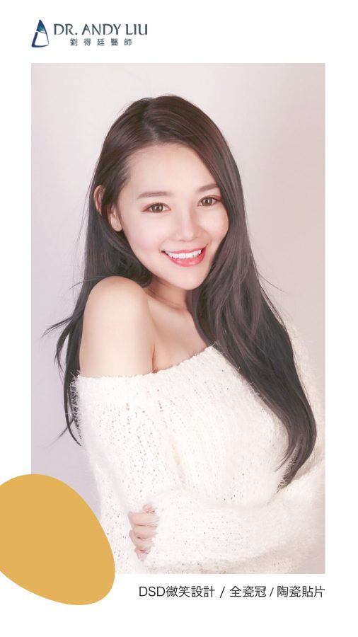 知名美女作家Livia的全瓷冠牙套+陶瓷貼片心得