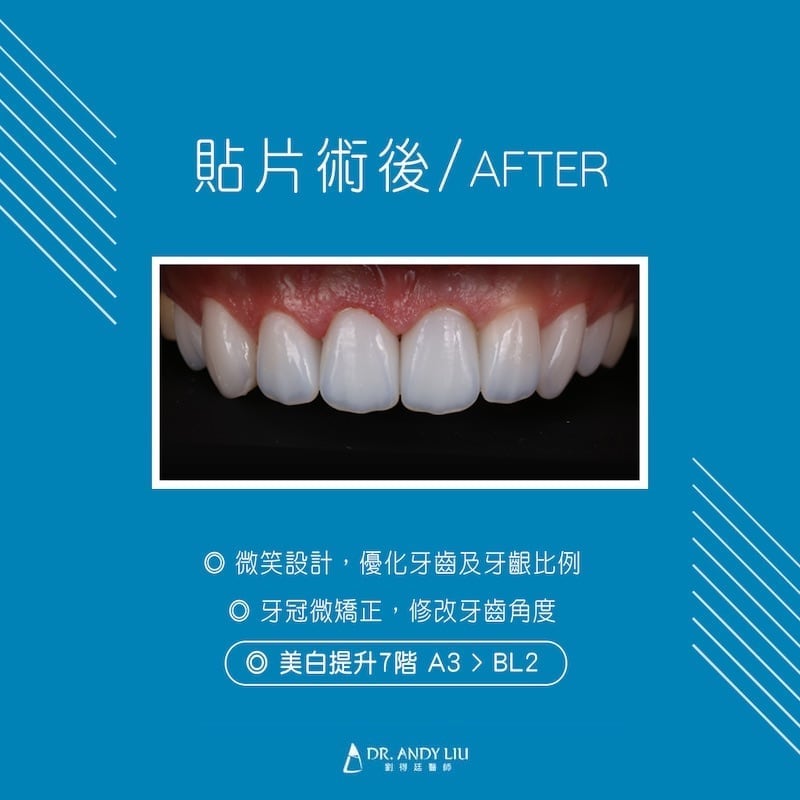 陶瓷貼片-全瓷冠-香港-根管治療牙套-抽神經牙齒黃-準新娘林小姐牙齒美白心得-術後照-DSD數位微笑設計修正牙齦比例與微矯正-並美白牙齒達七階