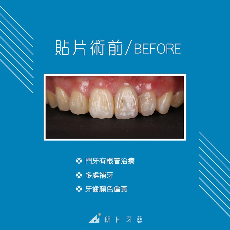 根管治療牙齒變黑-牙齒矯正-蛀牙-牙齒黃-陶瓷貼片療程前-台中-劉得廷醫師