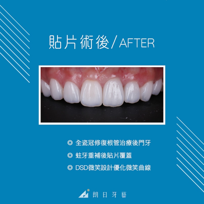 根管治療牙齒變黑-牙齒矯正-牙齒黃-DSD微笑設計-陶瓷貼片療程後-台中-劉得廷醫師