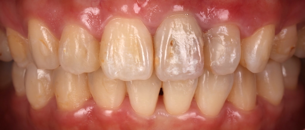 根管治療牙齒變黑-牙齒矯正-蛀牙-牙齒黃-陶瓷貼片療程前-牙齒近照-台中-劉得廷醫師