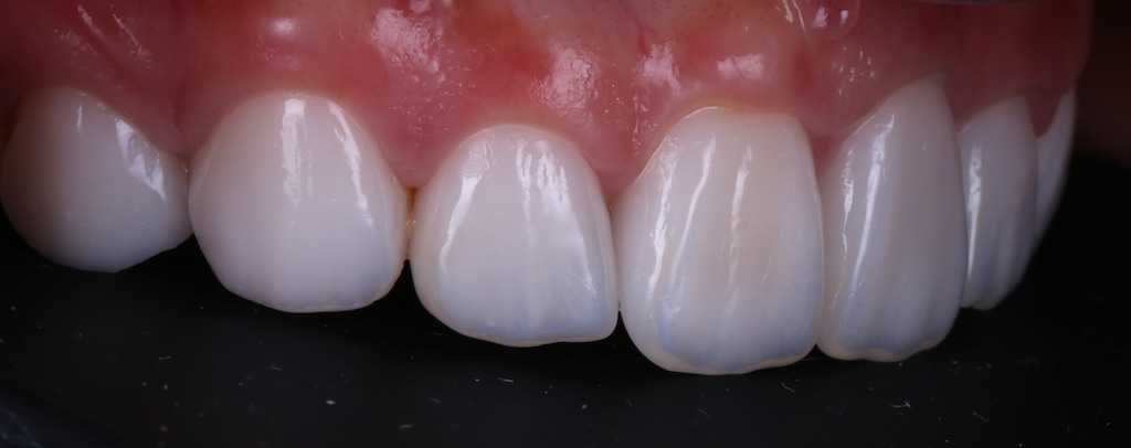根管治療牙齒變黑-牙齒矯正-牙齒黃-DSD微笑設計-全瓷冠-陶瓷貼片療程後-牙齒右側面照-台中-劉得廷醫師