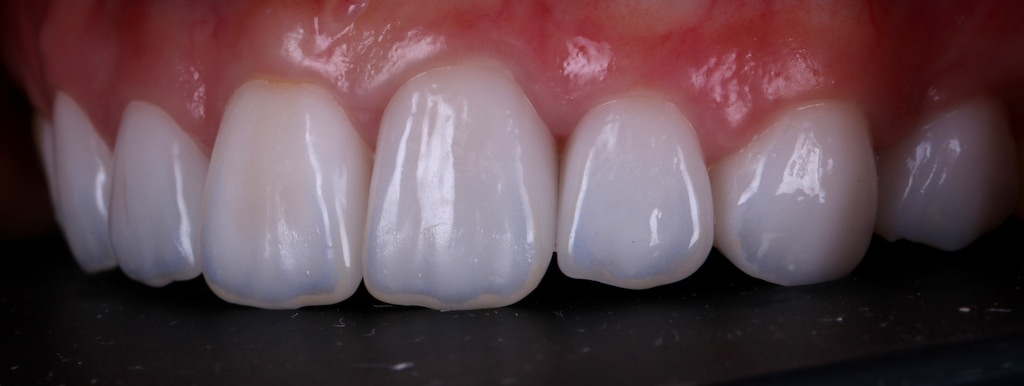 根管治療牙齒變黑-牙齒矯正-牙齒黃-DSD微笑設計-全瓷冠-陶瓷貼片療程後-牙齒左側面照-台中-劉得廷醫師