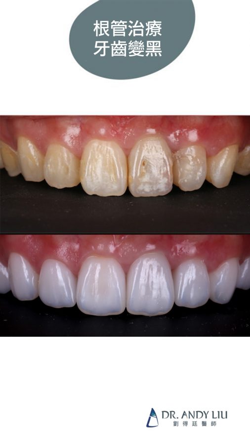 牙齒矯正後變黃、根管治療牙齒變黑，用陶瓷貼片一次解決！