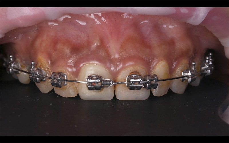 戴牙套-牙齒矯正-牙齒黃-陶瓷貼片前-牙齒美白-台中-劉得廷醫師