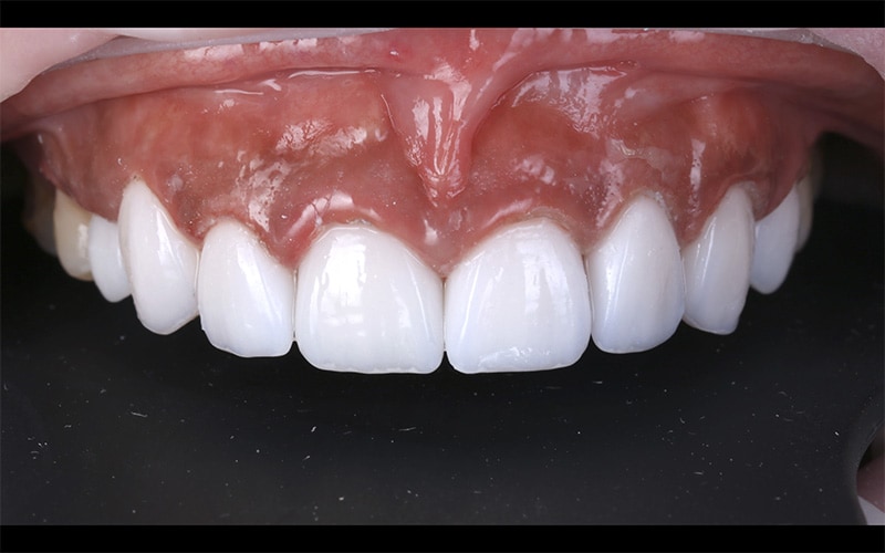 戴牙套-牙齒矯正-牙齒黃-陶瓷貼片後-牙齒美白-DSD數位微笑設計-台中-劉得廷醫師