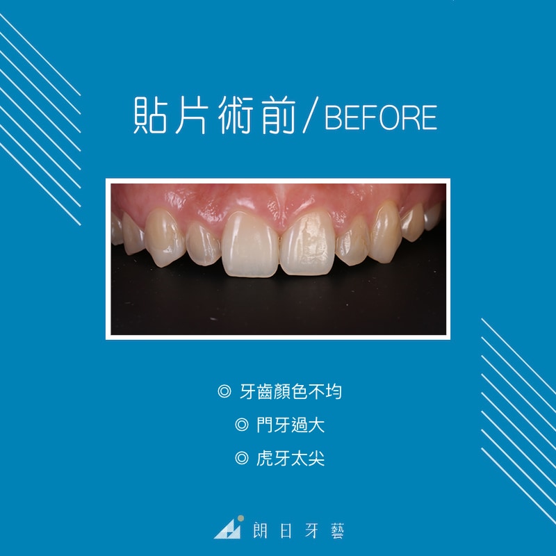 陶瓷貼片-牙齒形狀不好看-牙齒黃-虎牙尖-陶瓷貼片療程前-台中-劉得廷醫師