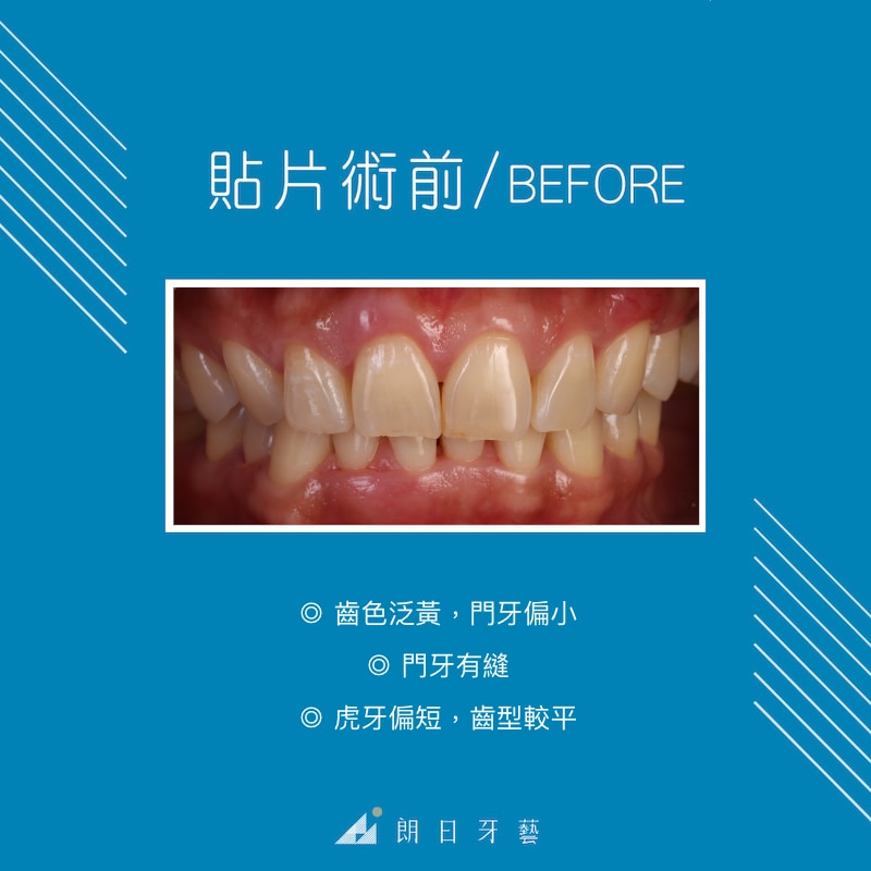 陶瓷貼片療程前-牙齒黃-門牙縫-門牙偏小-台中陶瓷貼片推薦-劉得廷醫師