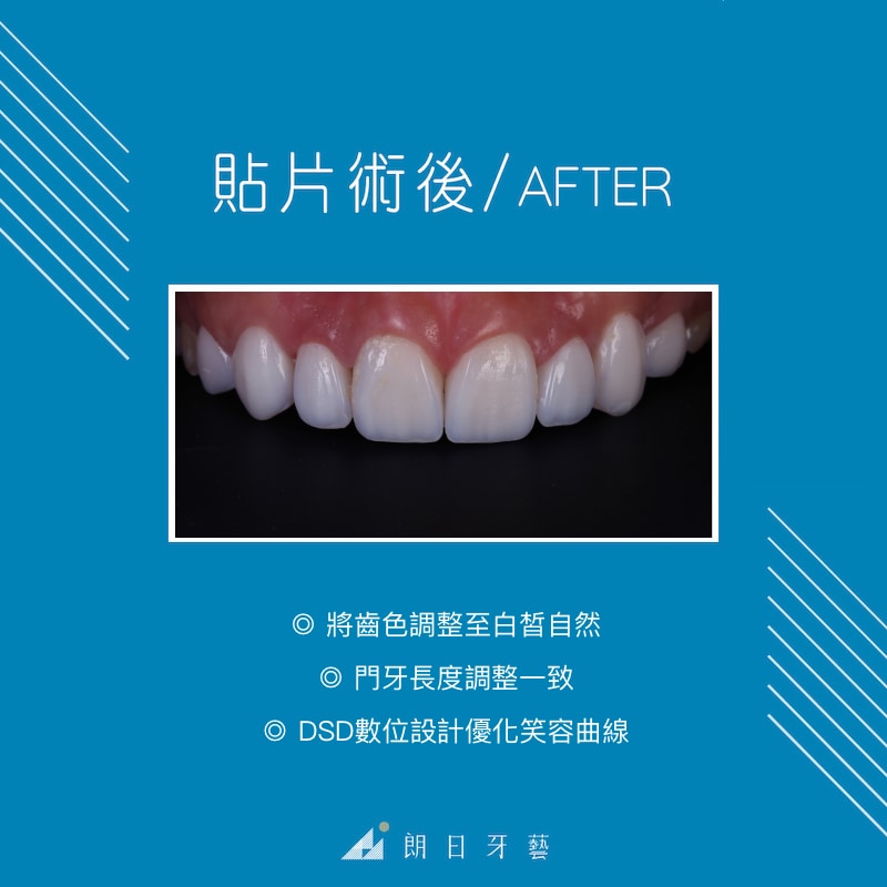 陶瓷貼片-牙齒形狀不好看-牙齒黃-虎牙尖-陶瓷貼片療程後-DSD數位微笑設計-一日美齒-台中-劉得廷醫師