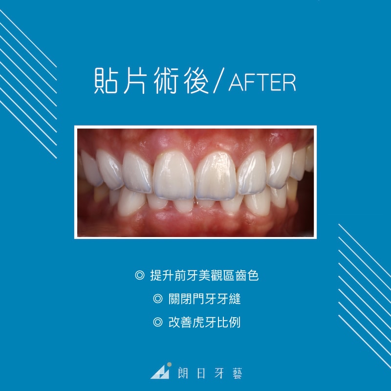 陶瓷貼片療程後-牙齒美白-關牙縫-DSD數位微笑設計-台中陶瓷貼片推薦-劉得廷醫師