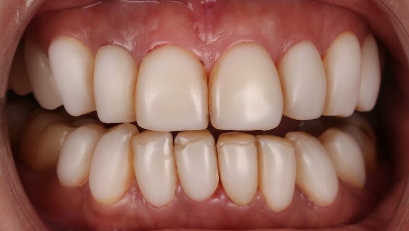 樹脂貼片-牙齒貼片失敗-不良牙齒美白貼片拆除前-前牙咬合-台中陶瓷貼片-推薦-劉得廷醫師