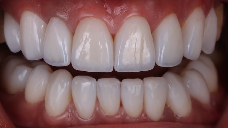 樹脂貼片-牙齒貼片失敗-不良牙齒美白貼片拆除後-前牙咬合-台中陶瓷貼片-推薦-劉得廷醫師